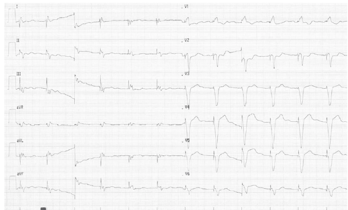 EKG pacienta.