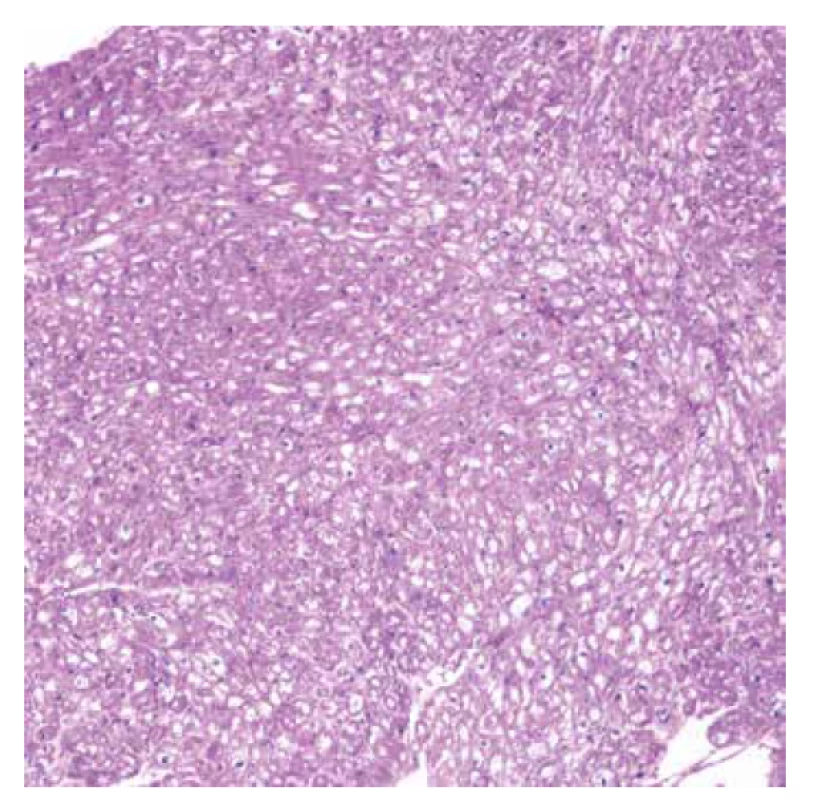 Endomyokardiální biopsie. Přehled jednoho ze vzorků ukazuje difúzní
vakuolizaci myocytů, bez plošných nekróz, bez zánětlivé celulizace (HE,
objektiv 10x).