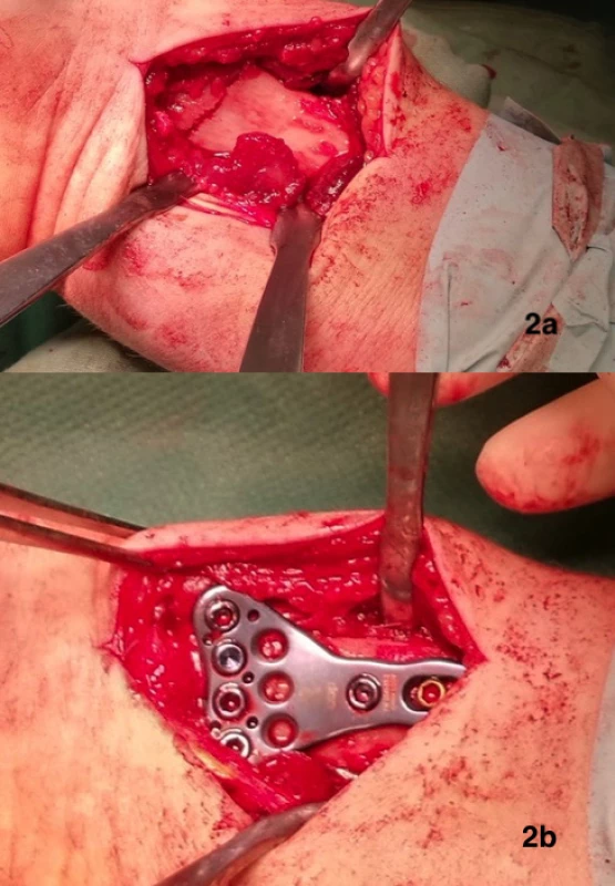 2a – operační přístup, 2b – definitivní pozice dlahy<br>
Fig. 2: 2a – surgical approach, 2b – definitive position of
the plate