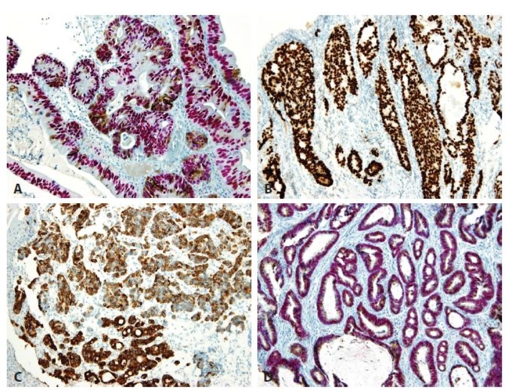 Immunohistochemical findings. A. High-grade hybrid dysplasia with nuclear CDX2 positivity (red) and cytoplasmic MUC5AC
expression (brown) in cells. No cell with negativity of CDX2 and positivity of MUC5AC is seen. B. Esophageal adenocarcinoma of
intestinal type shows CDX2 nuclear positivity. C. Esophageal adenocarcinoma of foveolar gastric type is positive for MUC5AC. D.
Esophageal adenocarcinoma of hybrid type. The nuclei are positive for CDX2 (red) and cytoplasm for MUC5AC (brown). No cell with
negativity of CDX2 and positivity of MUC5AC is seen (original magnifications 400x in A, 100x in B-D, respectively).