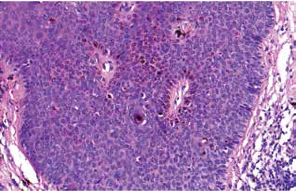 Histologický nález z probatorní excize – dysplastický
epitel, atypické mitózy, množství melaninu v epidermis