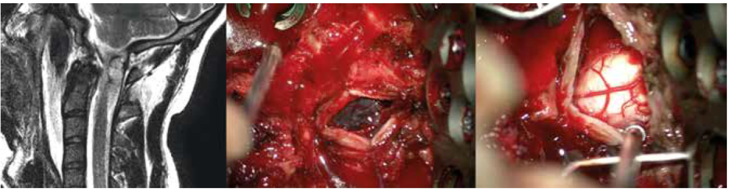 Akutní subdurální hematom komprimující přechod prodloužené a horní krční míchy<br>
Fig. 4. Acute subdural hematoma compressing the junction of the brainstem and upper cervical spinal cord