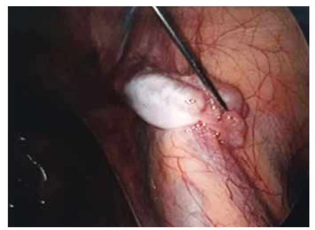 Hypoplazie pravých adnex.<br>
Fig. 3. Hypoplasia of the right adnexa.