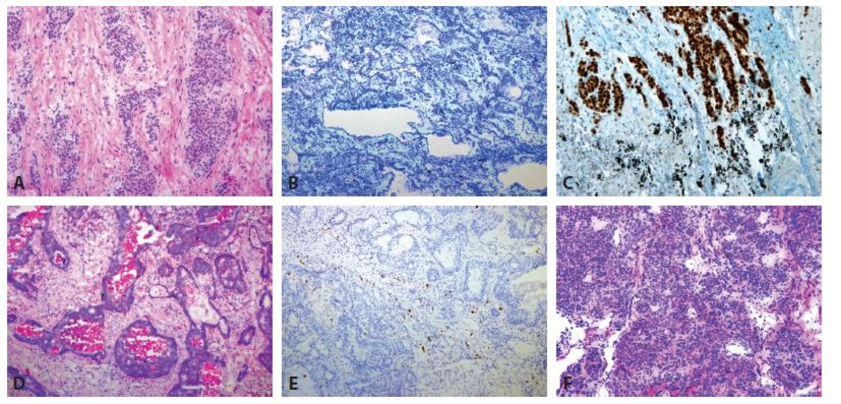 Maligní nádorová ložiska v peroperačním vyšetření. A, B: Primárně plicní adenokarcinom (zvětšení 40x, A HE, B Toluidinová modř). C: Peroperační imunohistochemický
průkaz TTF-1 primárně plicního adenokarcinomu (zvětšení 100x, TTF-1). D: Metastáza kolorektálního karcinomu s komedo-like nekrózami
(zvětšení 40x, HE). E: Negativní výsledek peroperačního imunohistochemického vyšetření TTF-1 (zvětšení 40x, TTF-1). F: Typický karcinoid (zvětšení 40x, HE).
