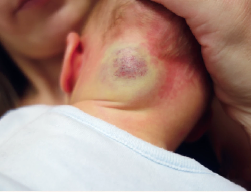 Smíšený hemangiom v oblasti šíje.<br>
Mixed nape hemangioma.