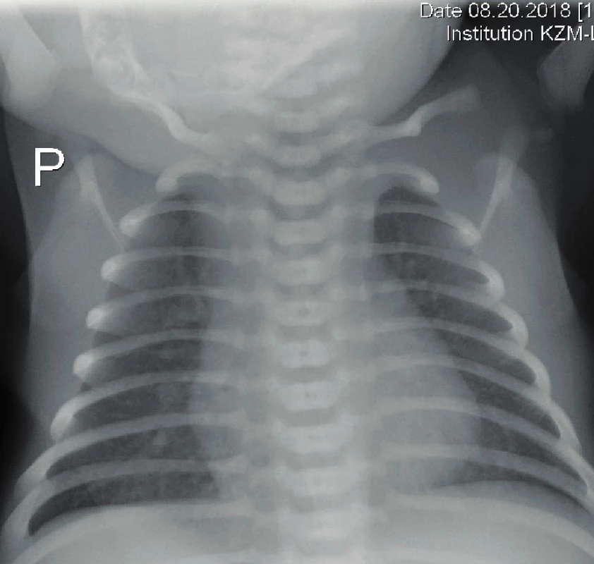 Rentgen hrudníku – normální nález na plicích ve věku
13 dní.<br>
Fig. 2. X-ray of the chest – normal finding at the age
of 13 days.