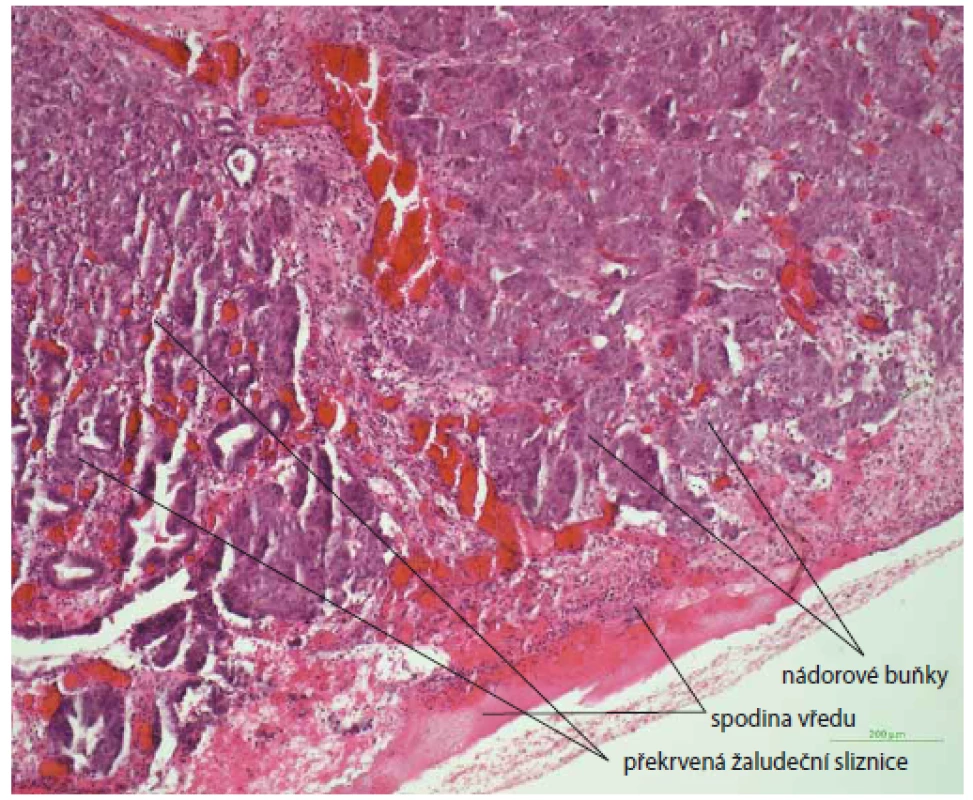 Histologický nález vredu žalúdku s infiltráciou nádorových buniek
(metastáza karcinómu prsníka), farbenie hematoxin-eozinom, zväčšenie 10×.<br>
Fig. 2. Histological image of stomach ulcer with infiltration of tumour cells (breast
carcinoma metastasis), haematoxylin-eosin staining, magnifi cation 10×.