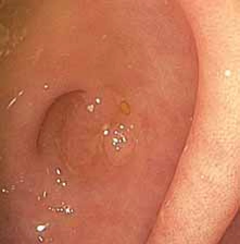 Koloskopický obraz léze dna 
céka při ústí appendixu 0–IIa dle Pařížské klasifikace.<br>
Fig. 1. Colonoscopic image of the 
cecum bottom lesion at the orifice of 
appendix 0–IIa according to the Paris 
classifi cation. 
