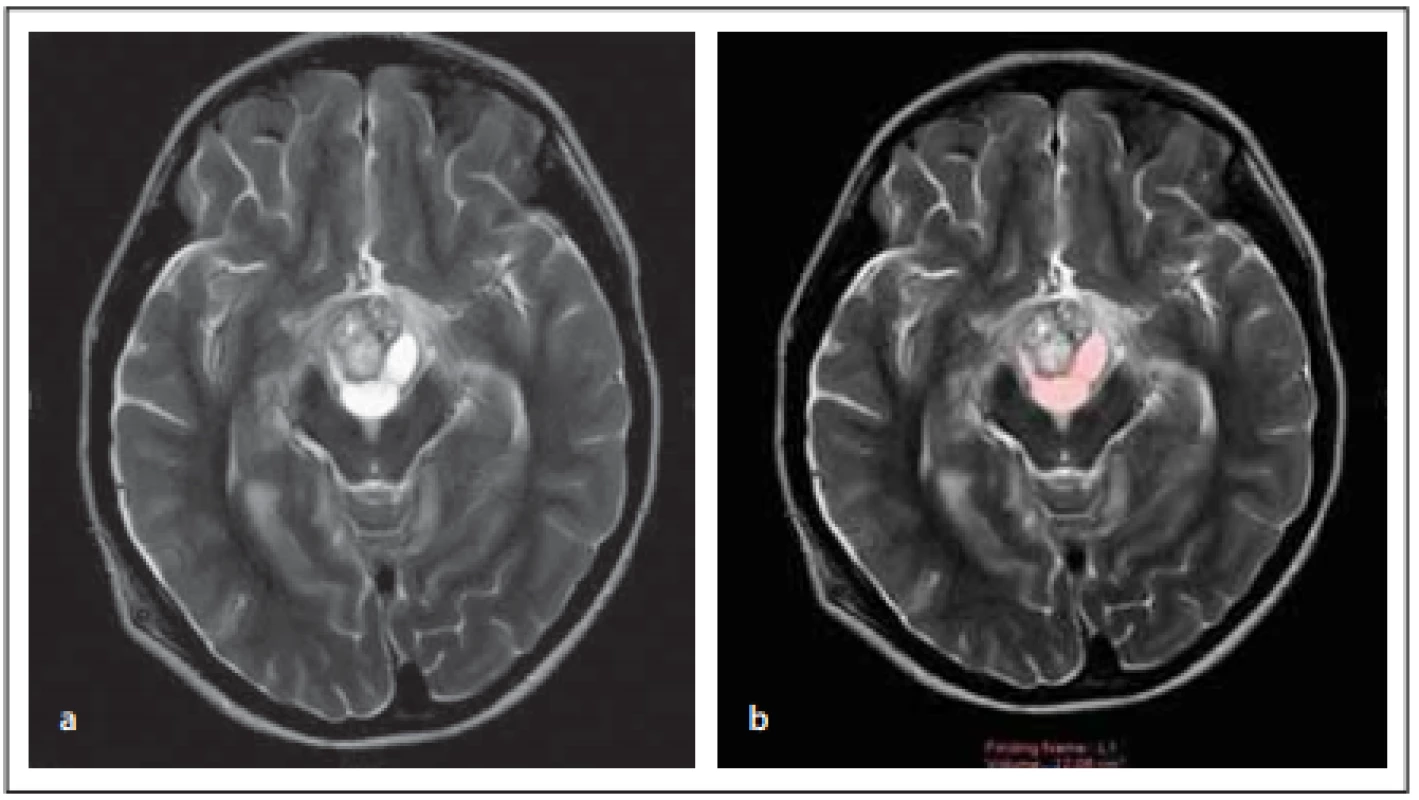 Female patient (12-year-old) – (A) cystic and solid components of the lesion 
on axial T2 images; (B) volume measurement of the cystic component of the lesion 
on axial T2 images.<br>
Obr. 2. Pacientka (12 let) – (a) cystická a solidní komponenta léze na T2 zobrazení 
v axiální rovině; (b) měření objemu cystické komponenty léze na T2 zobrazení v axiální 
rovině. 