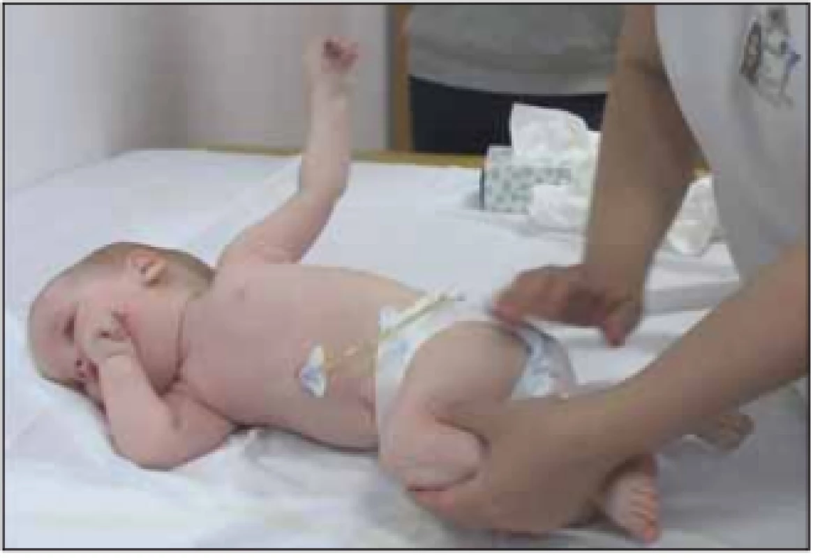  13měsíční batole (SMA I), terapie nusinersenem
od 3. měsíce věku, PEG od 1 rok věku.<br>
Fig. 4. A 13-month old child (SMA I), therapy with nusinersen
from 3 months of age, PEG from 1 year of age.