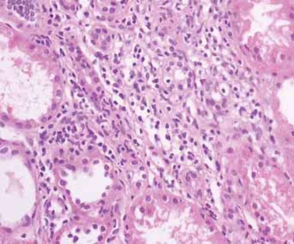 Histologické nálezy u pacientõ s IBD a renálním postižením (tubulointersticiální nefritida, glomerulonefritida, AA amyloidóza).<br>
Fig. 2. Biopsy pictures in IBD patients with renal illness
(tubulointerstitial nephritis, glomerulonephritis,
AA amyloidosis).