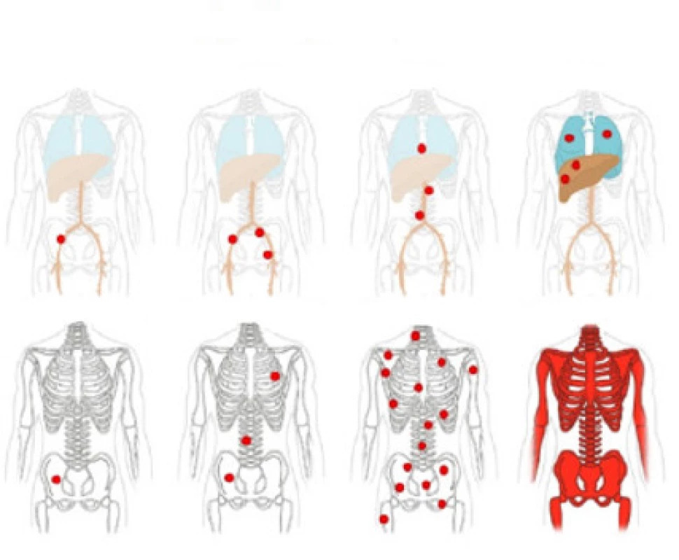 Hodnocení metastáz do lymfatických uzlin
a vzdálených metastáz; převzato z (14)<br>
Fig. 2. Evaluation of lymph node metastases and distant metastases