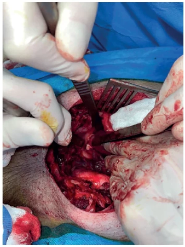 Pulmonary artery band in the pig model