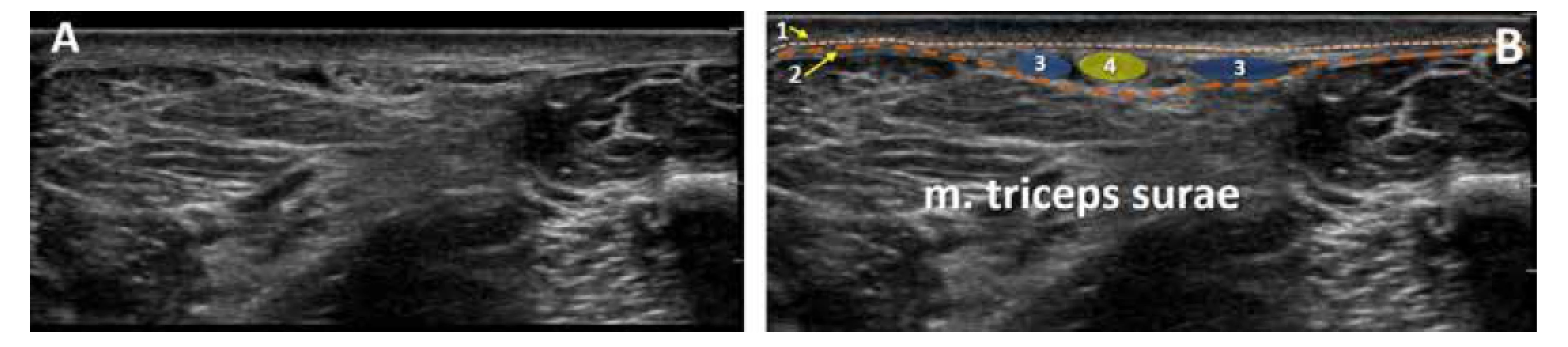 UZ obraz zadní střední části lýtka. A. nativní obraz. B. kolorovaný obraz: 1. povrchní fascie, 2. hluboká fascie, 3. vena saphena parva, 4. nervus suralis