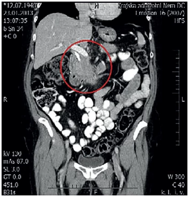 MDCT s nálezem tumoru hlavy pankreatu
V červeném kruhu zachycena oblast hlavy pankreatu. <br> 
Fig. 1: MDCT with pancreatic head tumor
The pancreatic head is captured in the red circle.