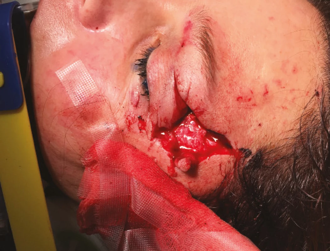 Deep wound of periocular region and upper eyelid in
patient following traffic accident