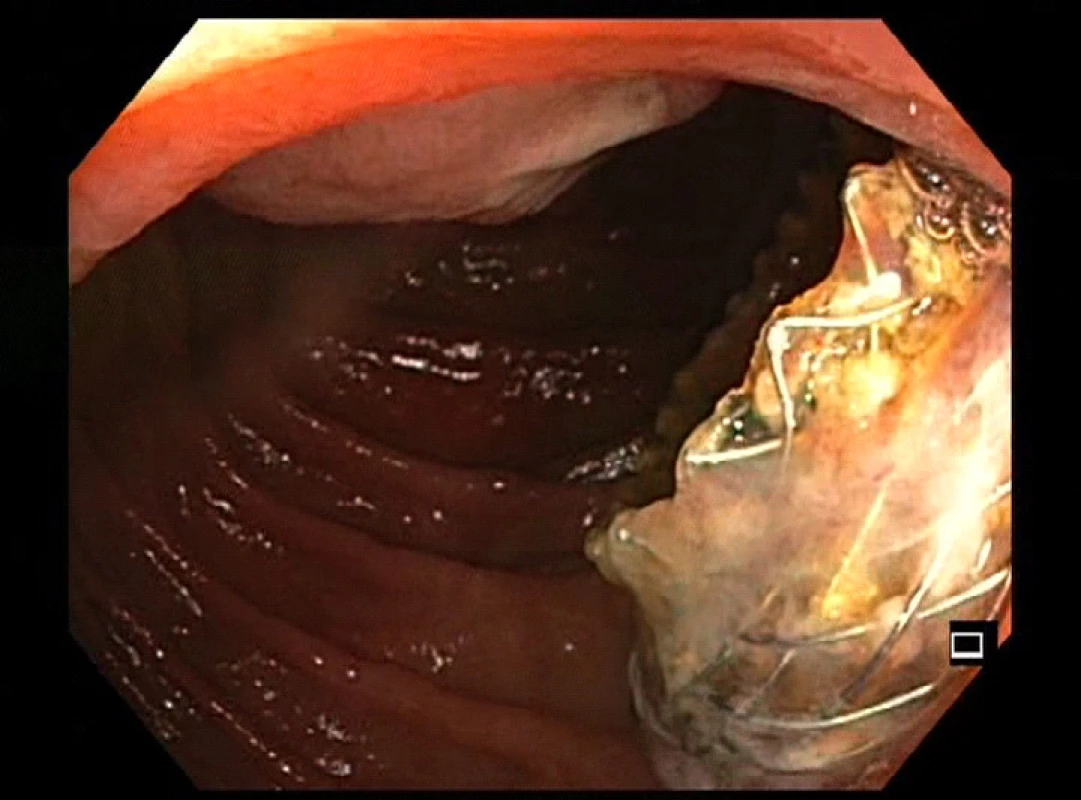 Jejuno-duodenostomie se zavedeným LAMS (lumen apoziční stent)<br>
Fig. 4: Jejunoduodenostomy with the placed LAMS (lumen apposing metal stent)