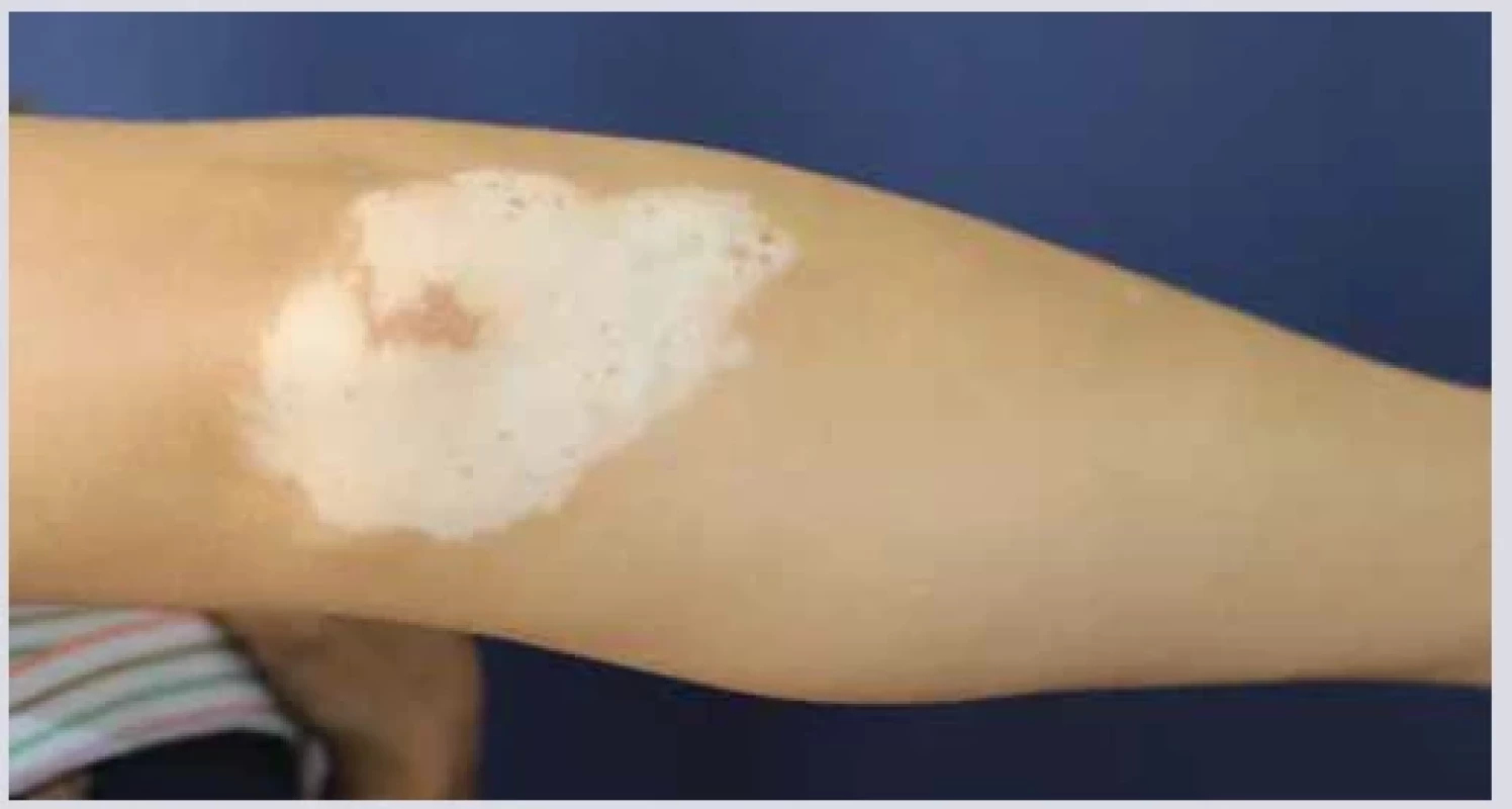 Vitiligo. <br> 
Fig. 12. Vitiligo.