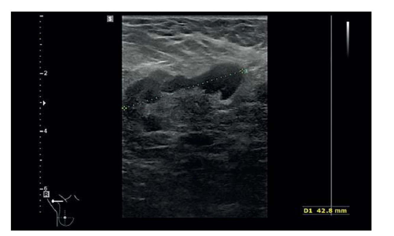UZ 12/2020, v pravé axile vícečetné zvětšené LU
do velikosti 43 mm s nepravidelně rozšířeným kortexem
– suspektní<br>
Fig. 2: Ultrasound 12/2020, multiple enlarged lymph nodes
sized up to 43mm with irregular cortical thickness –
suspicious