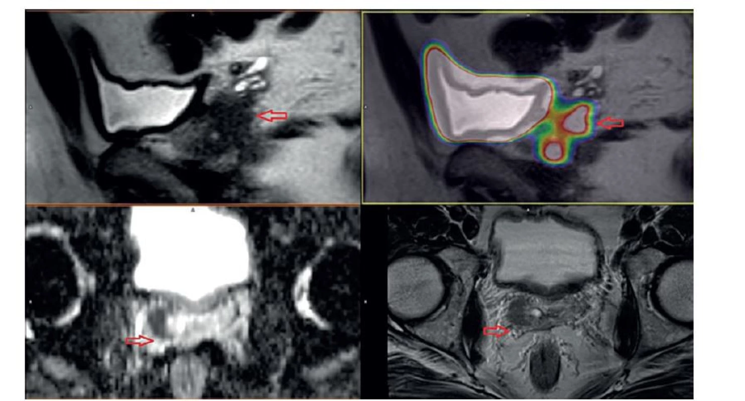 Karcinom prostaty v pravém laloku se šířením do semenného váčku (cT3b) [60]<br>
Fig. 1: Prostate cancer in the right lobe with right seminal vesicle invasion (cT3b) [60]