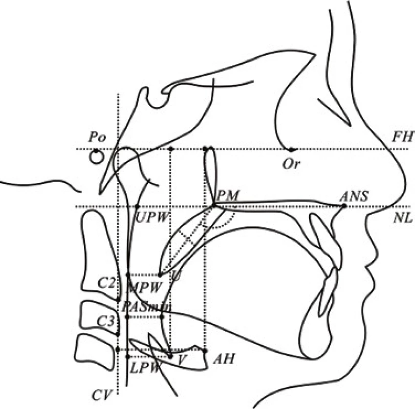 Cephalometric analysis and UR tract measurement used in the determination of cephalometric standards in 12-year-olds; taken from Min GU et al. [51]
Po – porion, Or – orbitale, ANS – anterior nasal spine, PM – pterygo-maxillare, U – uvula, UPW – upper pharyngeal wall, MPW – middle pharyngeal wall, LPW – lower pharyngeal wall, V – vallecula, AH – anterior hyoid, C2 and C3 - 2nd and 3rd cervical vertebrae, FH – Frankort horizontal plane, NL – nasal line, CV – cervical vertebrae, the line joining the C2 and C3
