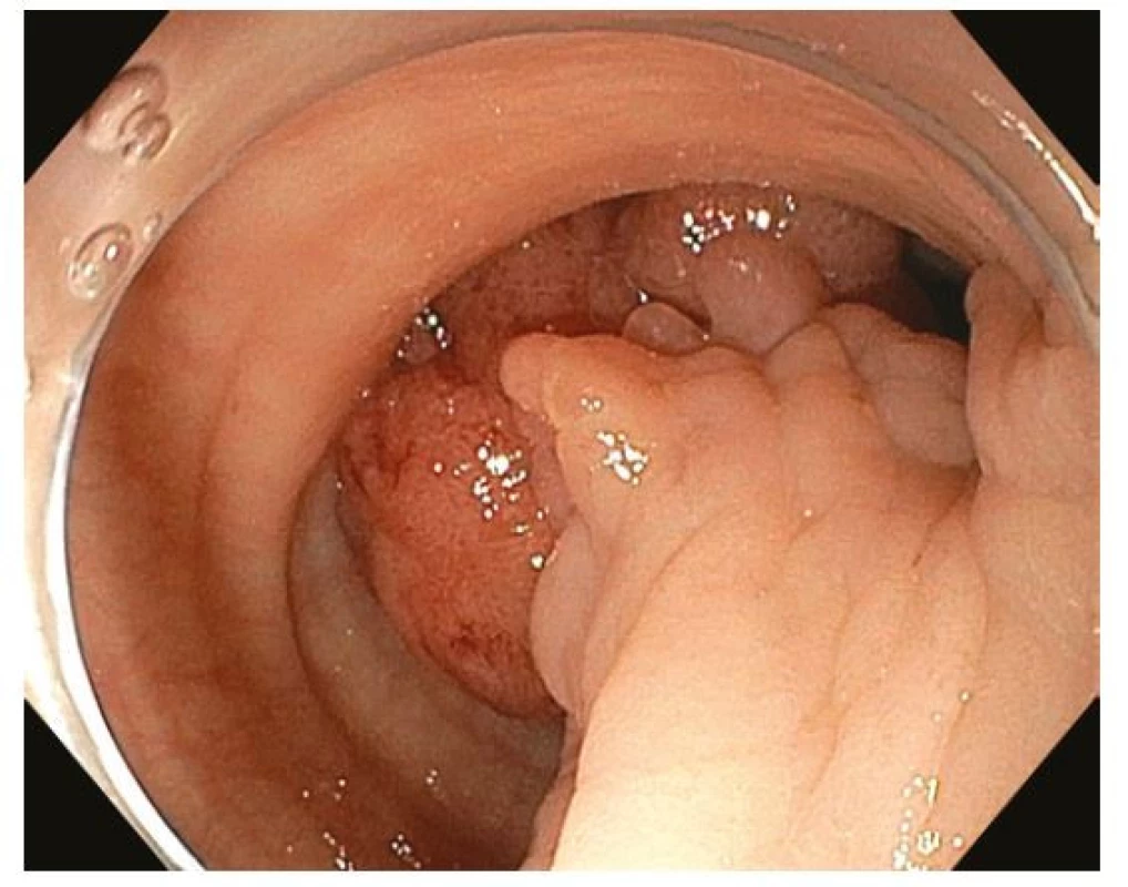 Endoskopická polypektomie – objemný stopkatý polyp 0-Ip sigmoidea
diagnostikovaný u pacienta s hematochezií
