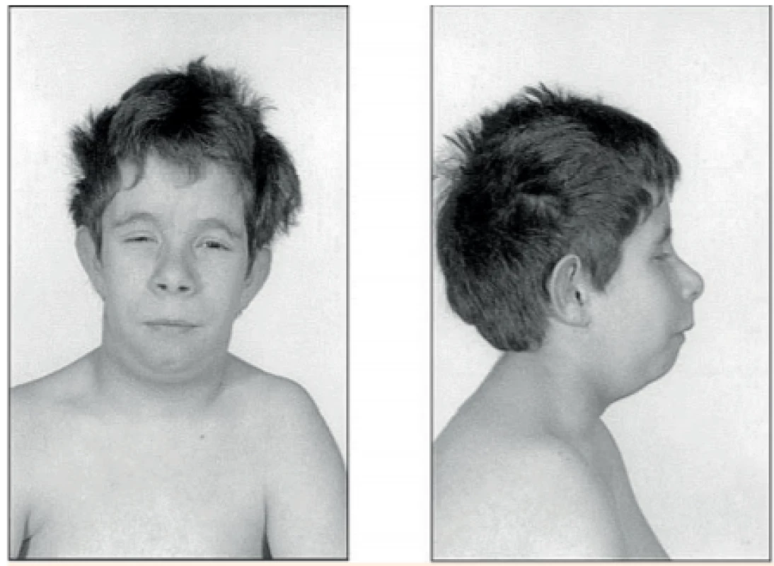 Fenotyp prvního diagnostikovaného pacienta s bialelickou delecí genu pro IGF-I. Chlapec prodělal těžkou
intrauterinní růstovou retardaci (porodní hmotnost
-3,9 SD). V 15 letech měl mikrocefalii, mentální retardaci, poruchu sluchu a závažnou růstovou poruchu (tělesná výška -6,9 SD). IGF-I bylo nedetekovatelné, IGF-BP3
5,8 mg/l, hladina inzulinu nalačno 27,3 mIU/l a hladina
růstového hormonu po stimulaci 61 μg/l (122 mIU/l)
(snímky a kazuistické informace převzaty z [21]).<br>
Fig. 3. Phenotype of the first diagnosed patient with biallelic IGF-I gene deletion. He suffered from severe
intrauterine growth restriction (birth weight -3.9 SD).
At age 15 years, he was microcephalic, intellectually
disabled, had hearing impairment and severely short
stature (body height -6.9 SD). IGF-I was undetectable,
IGFBP-3 5.8 mg/l, fasting insulin 27.3 mIU/l and stimulated growth hormone 61 μg/l (122 mIU/l) (photos and
clinical information overtaken from [21]).