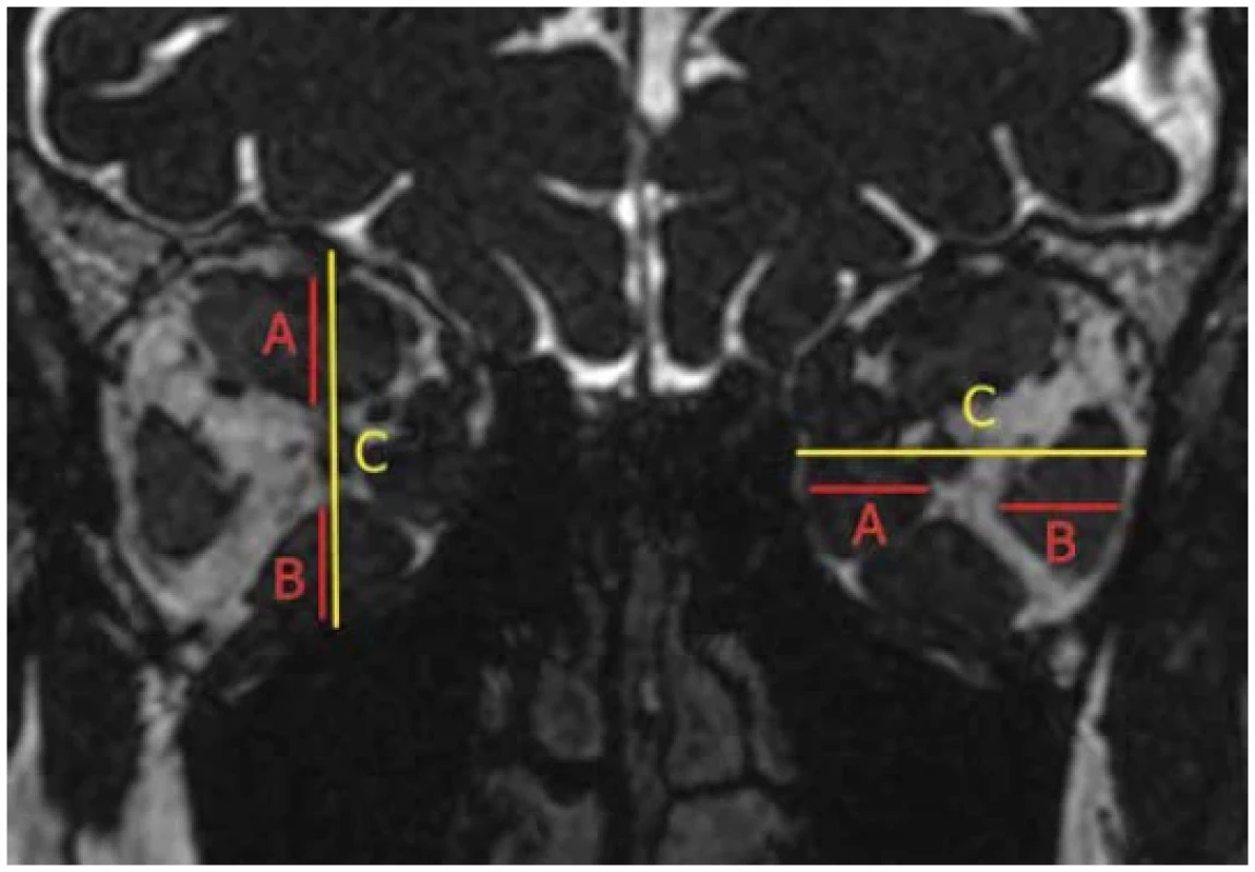 Thin MR coronal slice at a point halfway between the orbital apex and posterior
margin of the globe: technique for measuring Barrett's index based on measurements of
thickness of extraocular muscles (A, B) and orbital width/height (C) through the optic nerve
to assess the risk of dysthyroid optic neuropathy. The index is calculated for each eye separately
and both horizontal and vertical indices are measured, in which only the larger of the
two indices is taken into account. An index value of less than 50% almost excludes optical
neuropathy – calculation formula (A+B)/Cx100