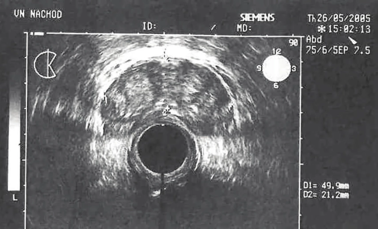 Hyperplazie prostaty s elevací PSA – ultrasonografie<br>
Fig. 2: Benign hyperplasia of the prostate, elevation in
PSA level – ultrasonography