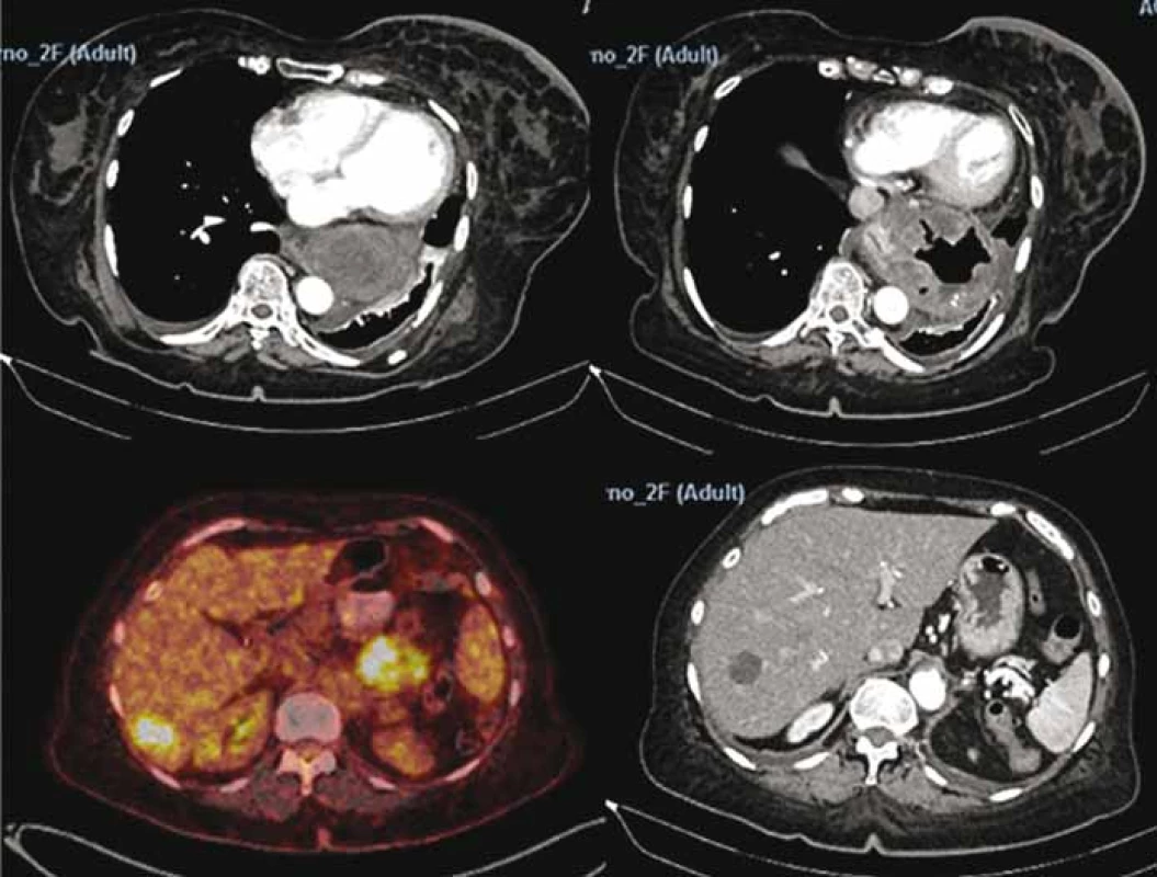 Positron emission tomography scan showing stomach gastrointestinal stromal
tumor and liver metastases.