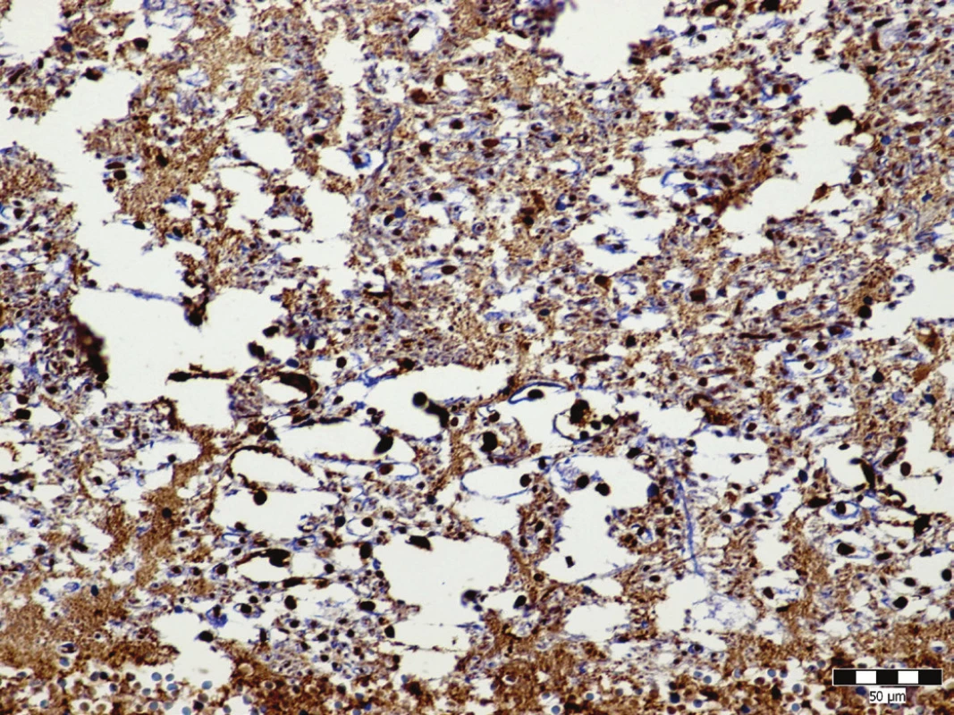 Anti-neuron specific enolase stained section of the dorsolateral pons
showing diffuse axonal injury (anti-NSE x400).