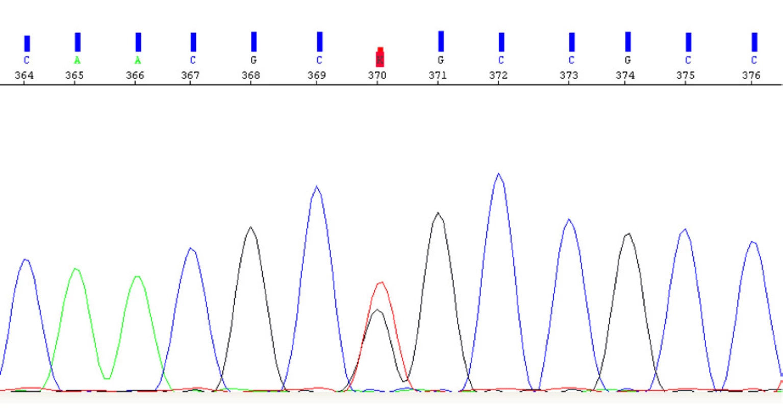 Elektroferogram části exonu 1 genu VHL s prokázanou patogenní variantou c.302T>G v heterozygotním stavu<br>
Fig. 11. Electropherogram of the part of 1 gene of VHL with a determined pathogenic variant c302T>G in a heterozygous state