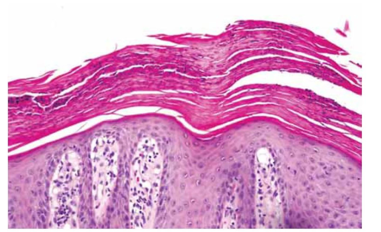 Hyperkeratóza.<br>
Fig. 3. Hyperkeratosis.