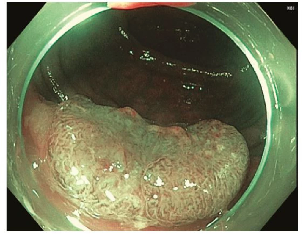 Léze descendens 0-IIa + IIc v módu NBI odpovídající typu 3 dle
NICE / JNET klasifikace, histologicky adenokarcinom s hlubokou submukózní
invazí