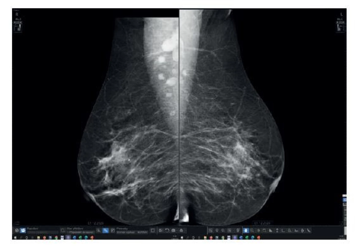 Skríningová MG v 12/2020, bez známek malignity,
v pravé axile zmnožené a zvětšené LU, MLO projekce<br>
Fig. 1: Screening MG, 12/2020; no signs of malignancy; increase
in the number and size of lymph nodes in the right
axilla, MLO projection