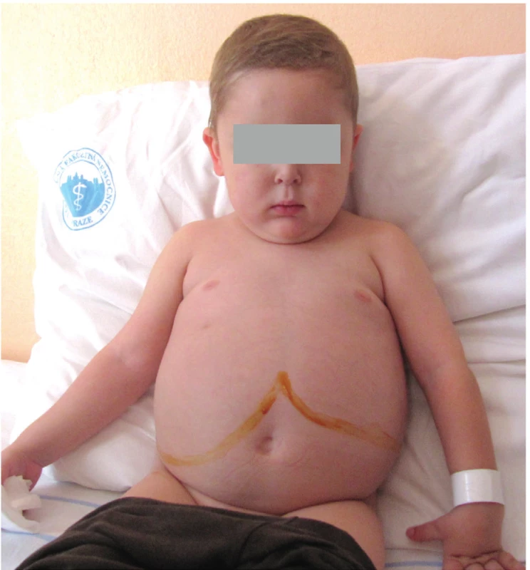 Extrémní hepatomegalie u 8letého chlapce s glykogenózou
typu III. Patrné je významné zvětšení pravého
i levého laloku jater, který v tomto případě zasahuje
až do levého hypochondria.<br>
Fig. 2. Extreme hepatomegaly in 8-year-old child with
Glycogenosis Type III. Both right and left liver lobes
were enlarged with the latter reaching left hypochondriac
region.