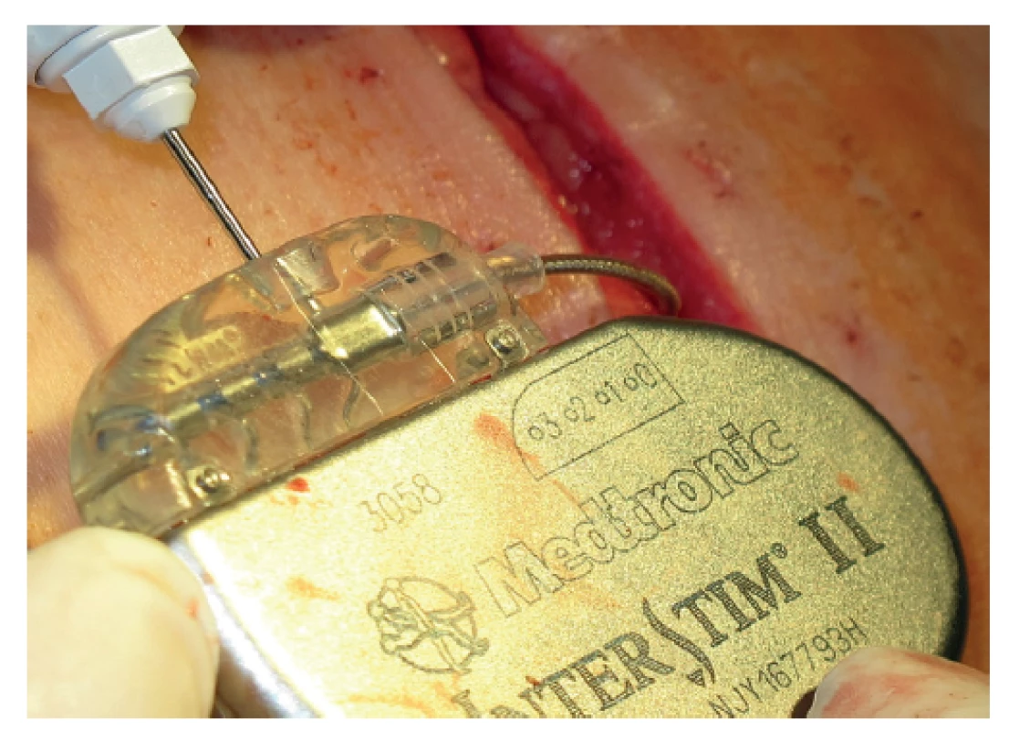 Připojení elektrody k neurostimulátoru Medtronic
InterStim II 3058<br>
Fig. 4: Connection of the electrode to the Medtronic Inter-
Stim II 3058 neurostimulator