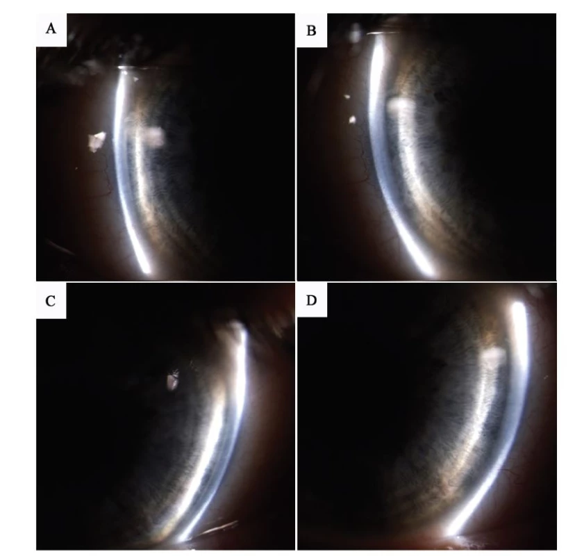 Anterior segment photography – documentation of anterior chamber depth, A) right eye before discontinuation of trazodone, B) right
eye after discontinuation of trazodone, C) left eye before discontinuation of trazodone, D) left eye after discontinuation of trazodone.