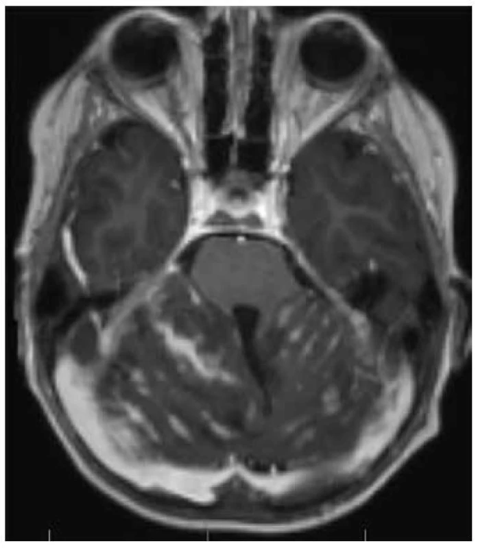 Meduloblastom group 3: recidiva rozsáhle metastazujícího tumoru
s leptomeningeálním infra i supratententoriálním metastatickým rozsevem,
postkontrastně leptomeningeální enhancement.