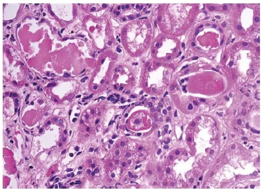 Detail vločkovitých bílkovinných válců v případě tzv. myelomové
ledviny. Barveno hematoxylinem eosinem (zvětšení 400x).