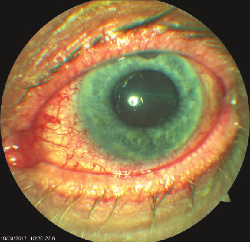 Objective finding in the left eye on 7th day after
trabeculectomy (TE) of LE