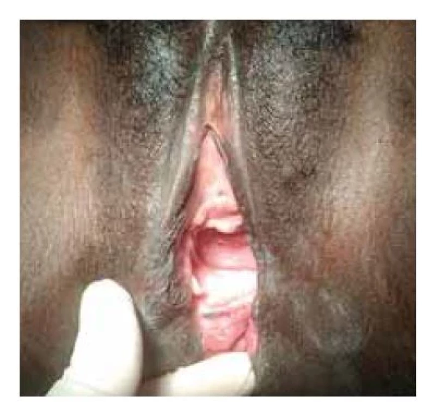 Před výkonem, publikováno
se svolením pacientky.<br>
Fig. 1. Before the procedure, published
with the permission of the patient.