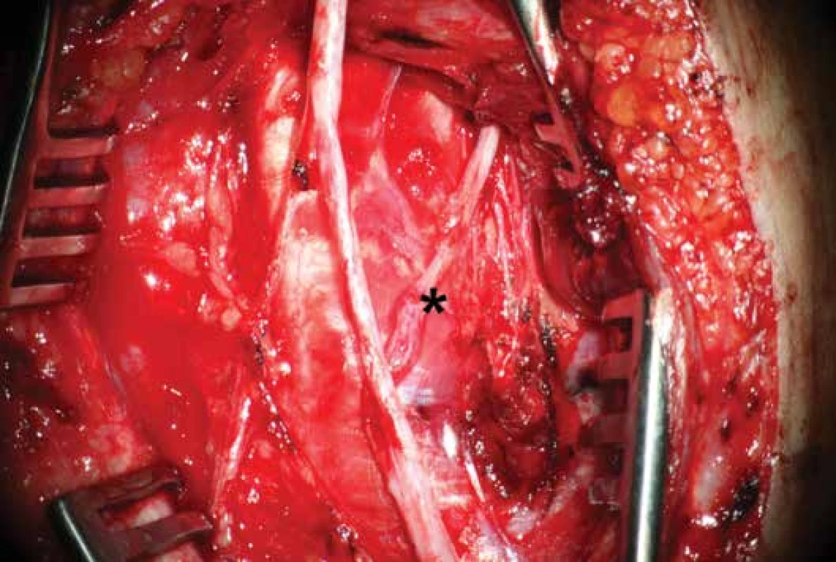 Pohled na dokončenou anastomózu
Přímá mikrochirurgická sutura větve n. interosseus anteberachii anterior na motorickou porci n. ulnaris (*) end-to-end.<br>
Fig. 2: Post-operative view
Direct end-to-end suture (*) of the branch of anterior interosseous nerve of the antebrachium with motor portion of the ulnar
nerve.