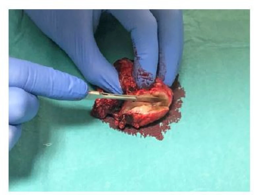 Příprava preparátu na IFS, krájení laterálního
okraje<br>
Fig. 3. Preparation of the prostate for IFS, slicing of
the lateral edge