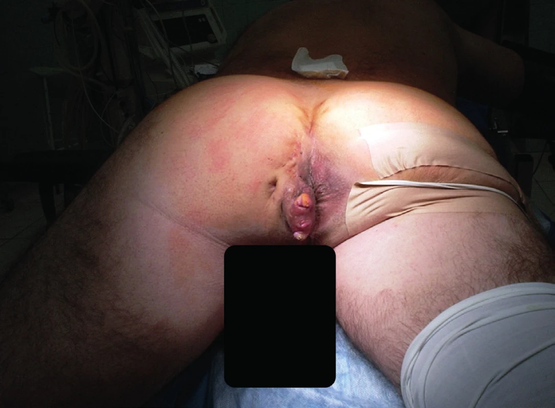 Předoperační nález<br>
Fig. 5: Preoperative finding