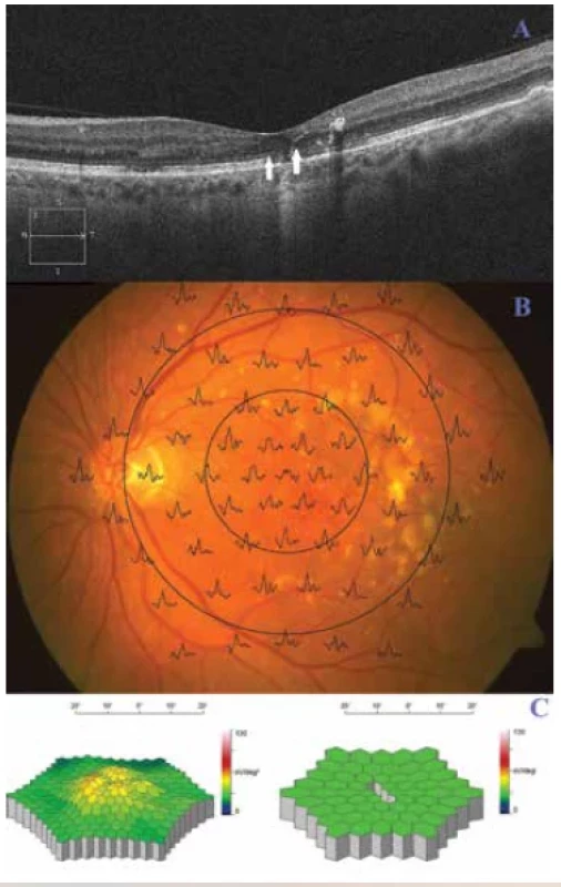 Oftalmologický nález pacientky z obr. 4 po rheoferéze.
(A) Optická koherenční tomografie levého oka nemocné.
Po rheoferéze došlo k přiložení DPED i ablace elipsoidů fotoreceptorů,
rizikového faktoru zvratu do vlhké formy VPMD. 2 drobná
ložiska defektů elipsoidní vrstvy považujeme za následek
předchozí ablace této vrstvy (šipky). (B) Superpozice mfERG odpovědí
na fundu levého oka pacientky. (C) Trojrozměrný obraz
elektrické aktivity sítnice levého oka, vzestup po léčbě; vpravo
porovnání s věkovou normou (zvýšení parafoveolarní aktivity do
normálního rozmezí)