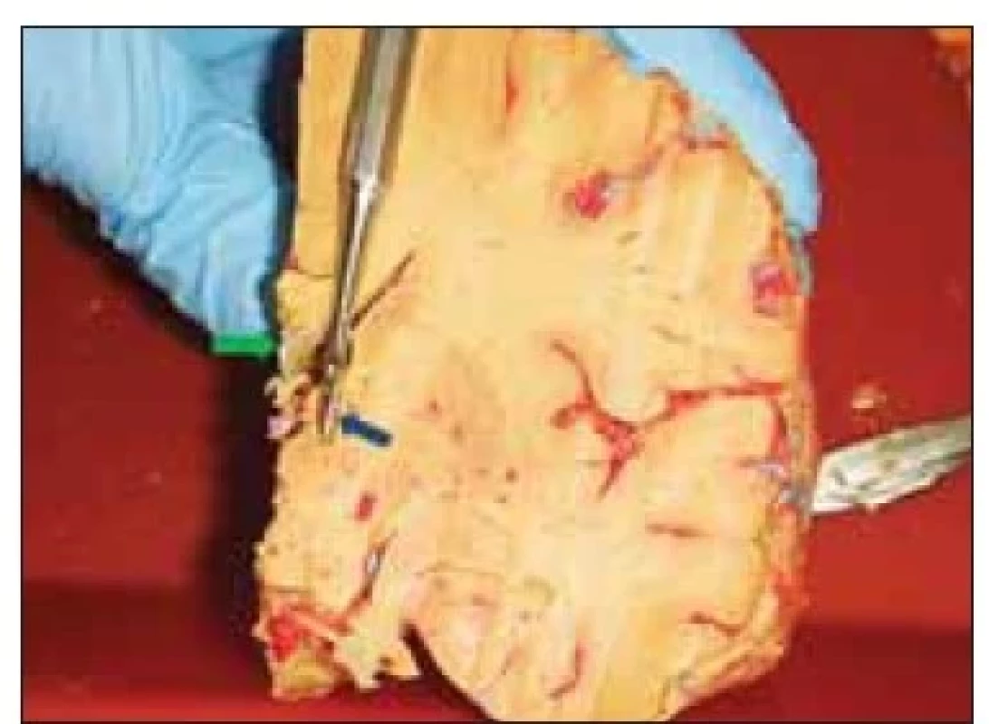Koronární řez mozkem v úrovni
nucleus anterior thalami – pátradlo ukazuje
průběh transventrikulární trajektorie
do nucleus anterior thalami (modrá šipka).
V blízkosti zamýšlené trajektorie patrna
subependymální žíla ve stropu postranní
komory (zelená šipka).<br>
Fig. 2. Coronal section of the brain at the
level of the anterior thalamic nucleus –
the probe shows the transventricular trajectory
to the nucleus anterior thalami
(blue arrow). Subependymal vein located
in the roof of the lateral ventricle in
the proximity of the intended trajectory
(green arrow).