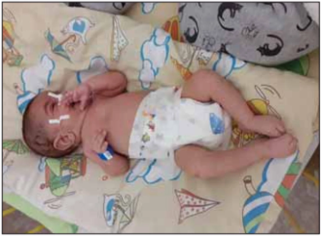 Floppy infant – SMA I.<br>
Fig. 2. A floppy infant – SMA I.