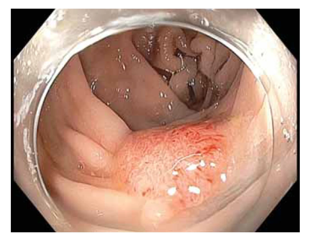 Lokální reziduální neoplazie (LRN) vel. 15 mm
v jizvě po endoskopické resekci sigmoidea.<br>
Fig. 3. Local residual neoplasia (LRN) size 15 mm in the scar
after endoscopic resection in the sigmoid.