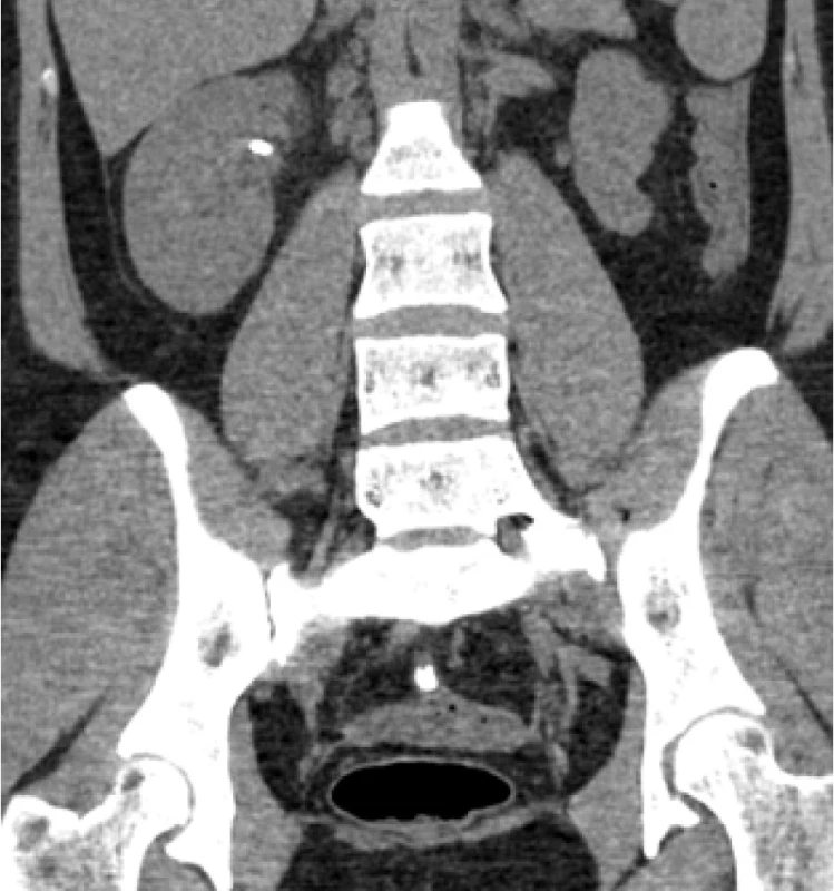Předoperační nativní spirální CT břicha (šipka
označuje konkrement)<br>
Fig. 1. Preoperative non-contrast helical CT scan (an
arrow showing the stone)